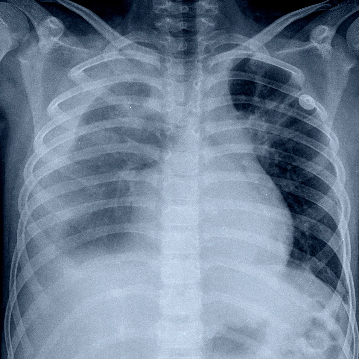 chest xray displaying pleural effusion caused by excessive accumulation of pleural body fluid